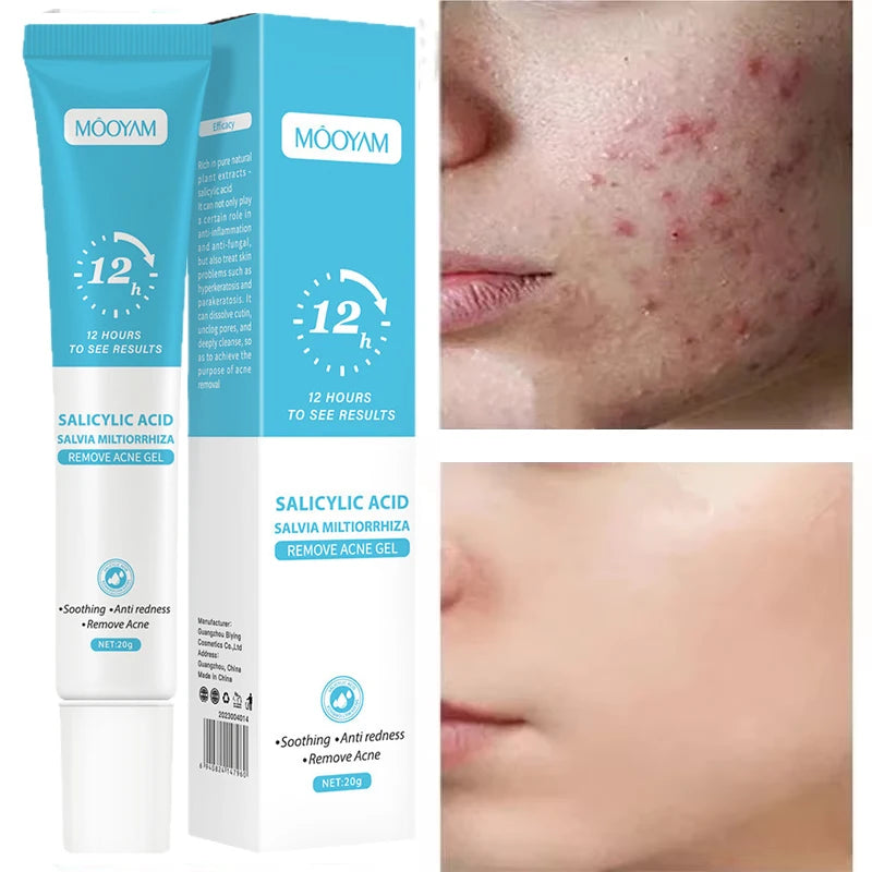 Acne Cream For Face Pimples Remover