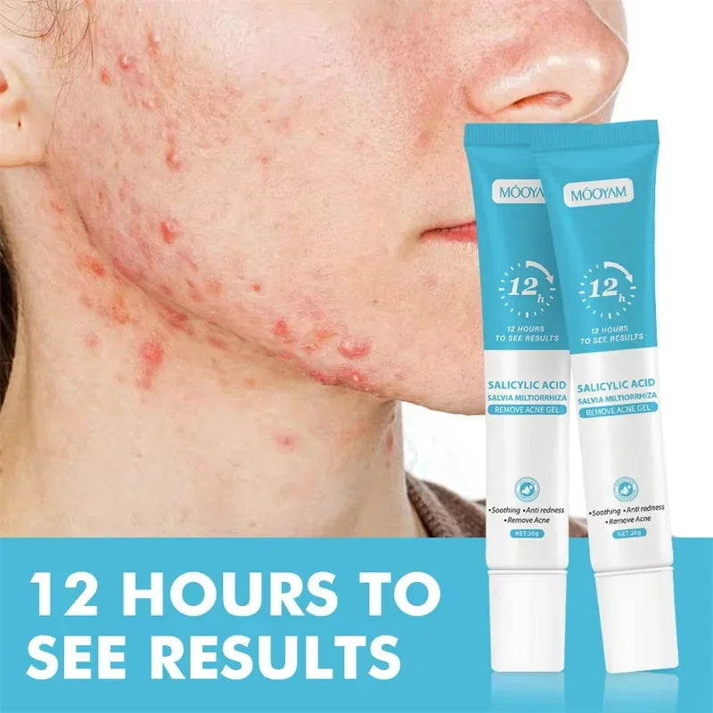 Acne Cream For Face Pimples Remover
