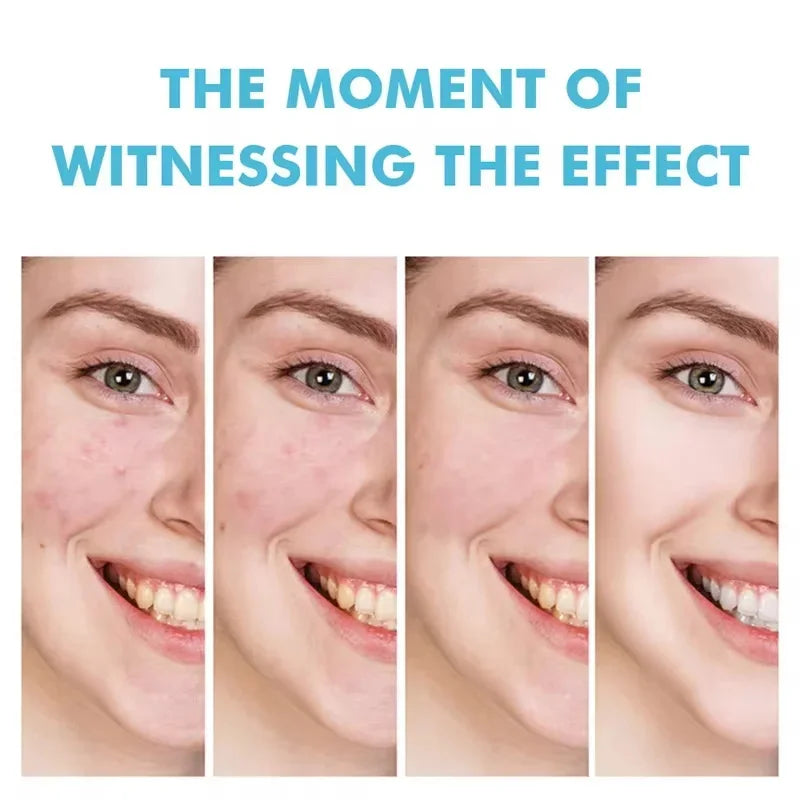 Acne Cream For Face Pimples Remover